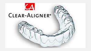 Jetzt NEU Clear-Aligner